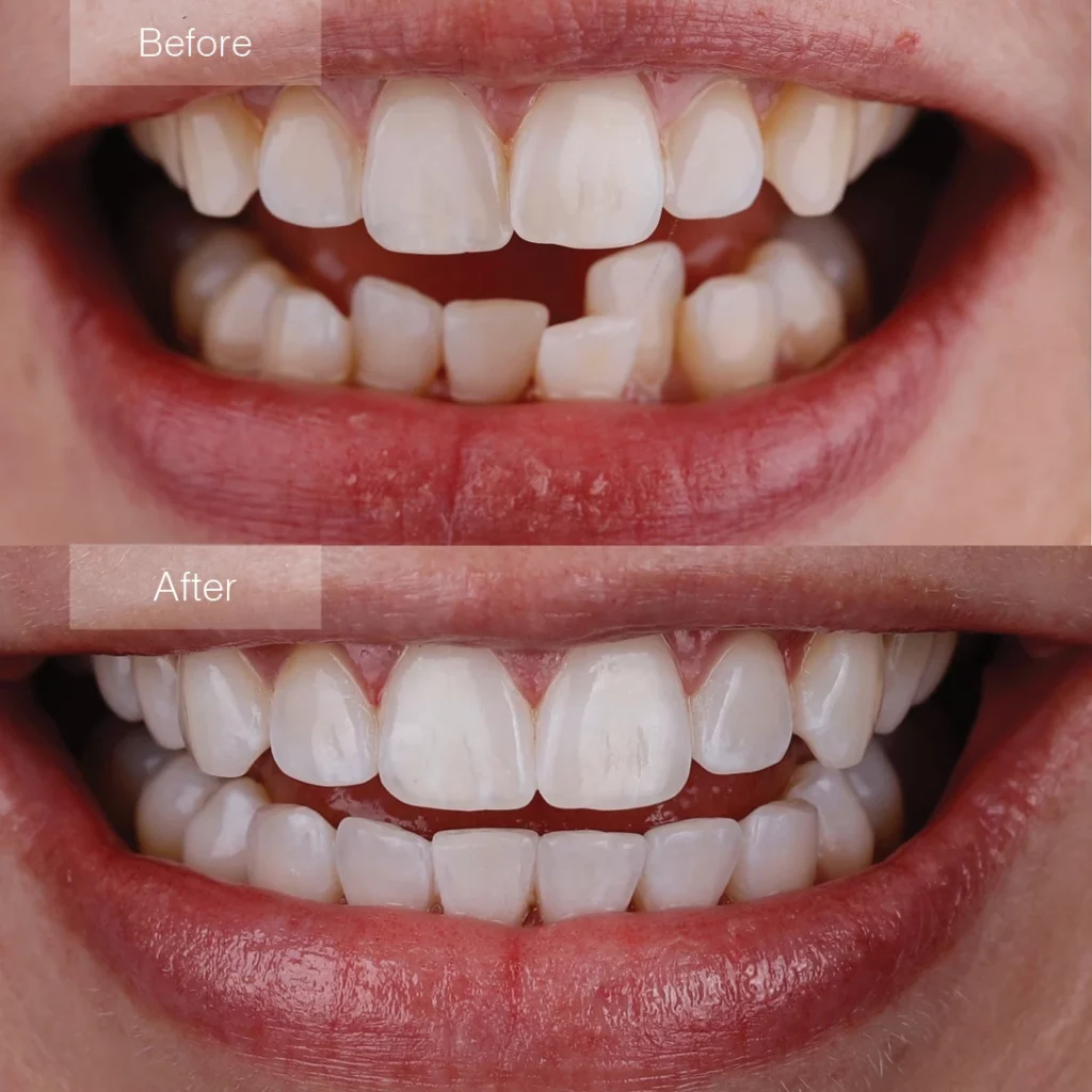 before and after clear aligners Danbury, CT