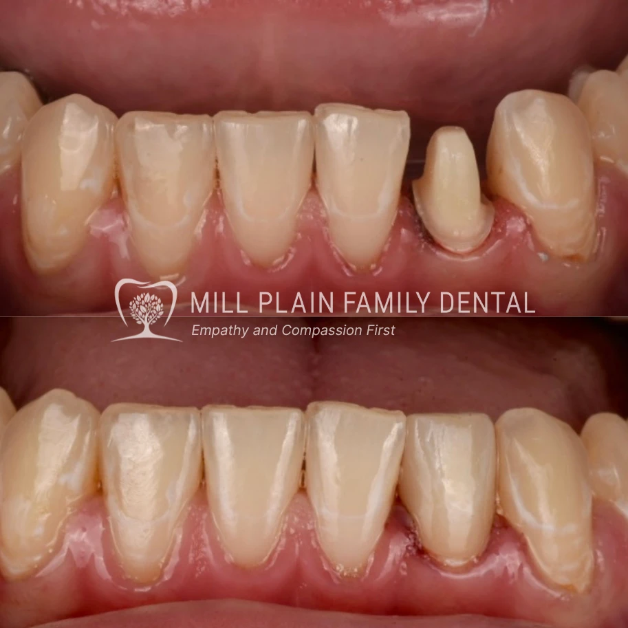 before and after veneers